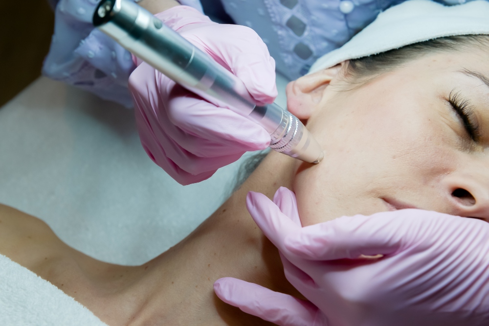 hydra filler microneedling nano threads